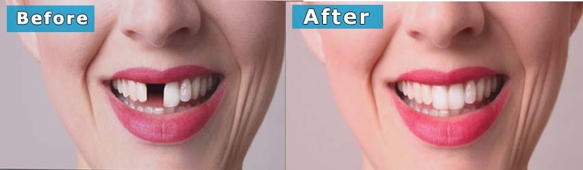 Discover the Benefits of Dental Implants at City Clinic Cork, Ireland